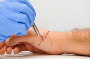 Doctor examining nerve conduction on palm of hand after carpal tunnel syndrome photo