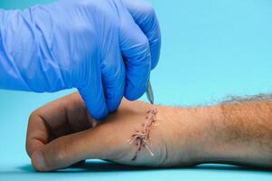 Suture wound on hand,Pain of accident concept photo