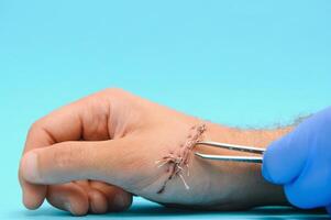 Examination and care of postoperative sutures on the patient's shoulder photo