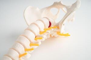 Lumbar spine displaced herniated disc fragment, spinal nerve and bone. Model for treatment medical in the orthopedic department. photo