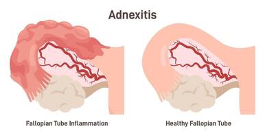 Salpingitis or adnexitis. Infection and inflammation in the fallopian tube vector