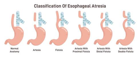 Esophageal atresia types set. Congenital medical condition of trachea vector