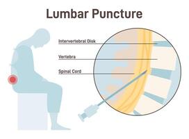 Lumbar puncture. Spinal tap, needle insertion into the space between vector