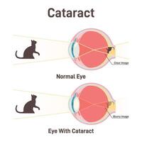 Cataract. Clouding of the lens, decrease of vision. Anatomical cross vector