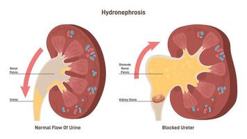 Hydronephrosis. Medical condition in which a kidney enlarge and swell vector