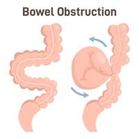 Bowel obstruction or volvulus. Loop of intestine twists around itself. vector