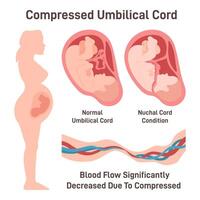 Compressed umbilical cord. Obstruction of blood flow through vector