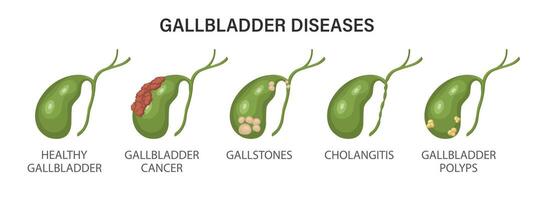 Gallbladder diseases infographics. Gallstone disease, cancer, acute cholecystitis, cholangitis or polyps of the digestive system. Problems with the biliary tract. Illustration. vector