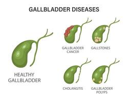 Gallbladder diseases infographics. Gallstone disease, cancer, acute cholecystitis, cholangitis or polyps of the digestive system. Problems with the biliary tract. Illustration. vector
