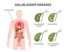 Gallbladder diseases infographics. Gallstone disease, cancer, acute cholecystitis, cholangitis or polyps of the digestive system. Problems with the biliary tract. Illustration. vector