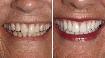 Before and after comparison of dental work showing a dramatic improvement in tooth whiteness and alignment with visible ageing signs. photo