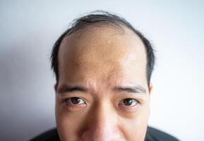 Cropped shot view of Asian man with sweating on his forehead cause of hot weather or etc. Sweat is actually the body's built-in cooling system when your body temperature rises. photo
