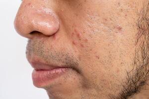 Close up of pores and pimples on men's nose and cheek. Nose pores are openings into the skin, where sebaceous glands produce and distribute the skin's natural oil. photo