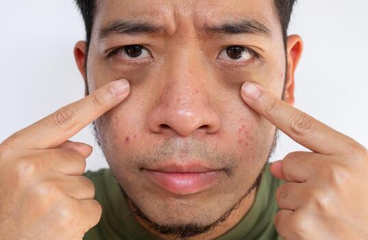 Close up of sleepless Asian man pointing to his under eyes having dark circles with puffiness problem. Using a collagen hydro gel under-eye mask can allow the skin to be soaked in moisture. photo