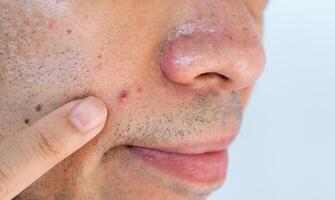 Close up of young man pointing acne occur on his skin. A pimple is a small inflammation or swelling of the skin that may or may not be filled with pus. photo