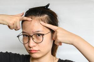 Portrait of woman trying to pointing problem of Acne and Scar from acne inflammation on her forehead. photo