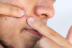 Close up of young man squeezing pimple or acne on his skin. A pimple is a small inflammation or swelling of the skin that may or may not be filled with pus. photo