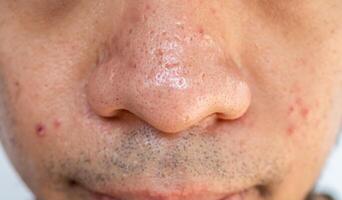Close up of pores and pimples on men's nose. Nose pores are openings into the skin, where sebaceous glands produce and distribute the skin's natural oil. photo