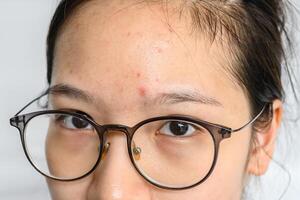 Close-up of woman forehead with the problem of Acne and Scar from acne inflammation on her forehead. photo