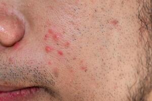 Close up of pores and pimples on men's cheek. Facial pores are a visible topographic feature of skin surfaces. photo
