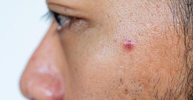Close up of acne inflammation on men's cheek. Facial pores are a visible topographic feature of skin surfaces. photo