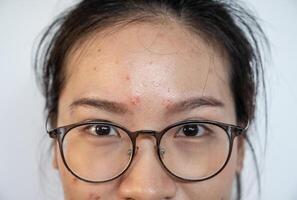 Close up of Asian woman having acne inflamed on her face. Inflamed acne consists of swelling, redness, and pores that are deeply clogged with bacteria, oil, and dead skin cells. photo