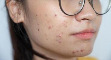Cropped shot of woman having acne inflammation on her cheek. Inflamed acne consists of swelling, redness, and pores that are deeply clogged with bacteria, oil, and dead skin cells. photo