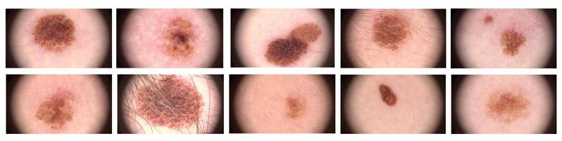 Complex melanocytic nevus. Dermatoscopy of the skin. Macro magnified 20 times with a dermatoscope microscope. A set of different nevus. Examination by a dermatologist. photo