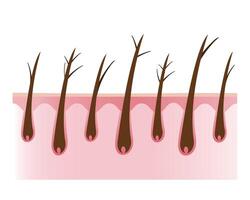 The cross section of damaged and types of split ends hair with scalp layer illustration isolated on white background. Dryness, baby split, y split and tree. Hair care and problem concept. vector