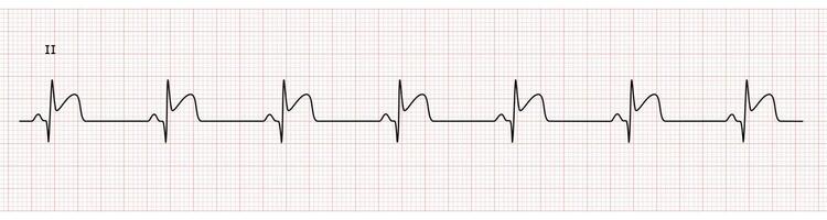 EKG Monitor in lead II Showing Sinus Rhythm with Late STEMI at Inferior Wall with Deep Q Wave vector