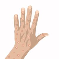 The hand of a person who got smallpox. vector