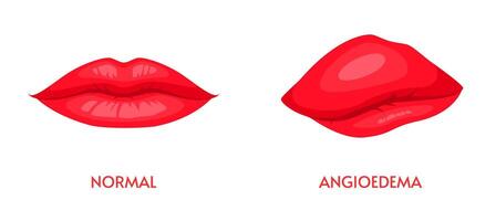 Angioedema or edema of lips, allergic swelling vector