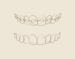 Jaws with and without braces installed drawing in linear style on beige background vector