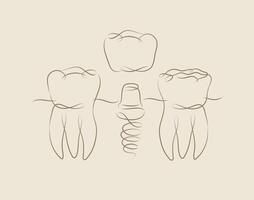 dientes implante ilustración dibujo en lineal estilo en beige antecedentes vector