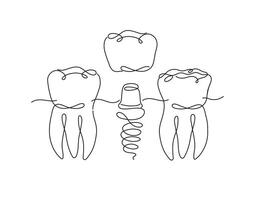 dientes implante ilustración dibujo en plano línea estilo en blanco antecedentes vector