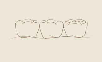 Implanted teeth with crown bridge illustration drawing in linear style on beige background vector