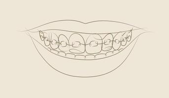 Smile with teeth braces in linear style drawing on beige background vector
