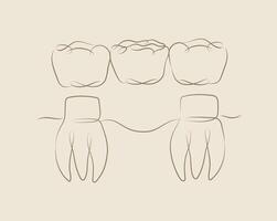 Teeth with crown bridge illustration drawing in linear style on beige background vector