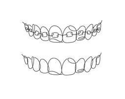 Jaws with and without braces installed drawing in flat line style on white background vector