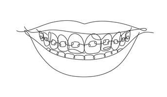 Smile with teeth braces in flat line style drawing on white background vector