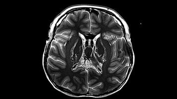 Detailed CT scan of a brain displaying advanced atrophy photo