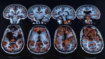 A series of CT scans displaying atrophy throughout the brain photo