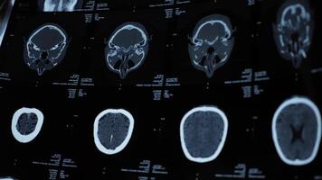 Magnetic resonance imaging of an older man's brain after a traumatic brain injury, which shows that the brain is damaged. Tomographic image of the head video