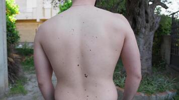 Back View Of A Boy With Many Moles On His Back video