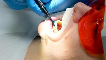 Whiten teeth liquid cofferdam to isolate the gums from the action of a bleaching agent optragat rotary spreader Teeth whitening procedure with ultraviolet light UV lamp. dentist in the clinic video