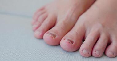 Subungual Hematoma on toenail are injuries of wearing shoes that are too tight in which bleeding develops under the nail. Crush injury to the distal phalanx fingernail or toenail, black toenail. 4k. video