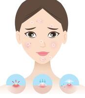 The woman is treating acne by pimple patches for inflammatory acne illustration on white background. Icon set of direction for use acne patch absorbing papule and pustule on skin face. vector