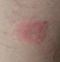 closeup view of skin showing signs of irritation or ringworm, with a reddish-pink rash that appears slightly raised and rough photo