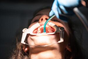 Dentist appointment at a dental clinic, placing braces locks on the teeth and pulling the archwire to fix it photo