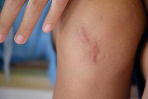 Scar is inflamed and red called keloids on children knee close-up in body parts blurred background concept of skin and wound for medical healthy skin care. photo